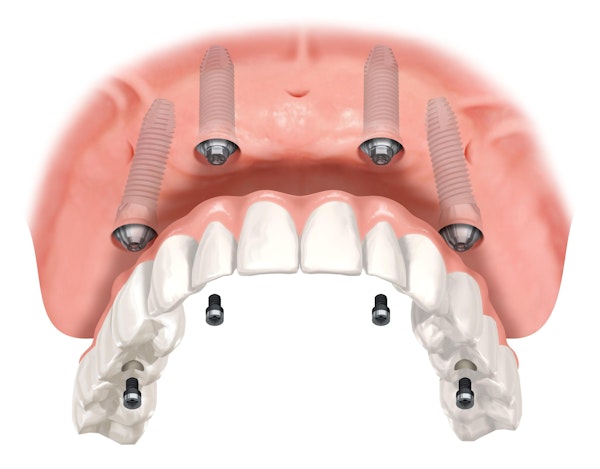 All-on-4 Dental Implants
