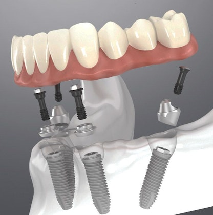 Illustration of All-on-4 implants