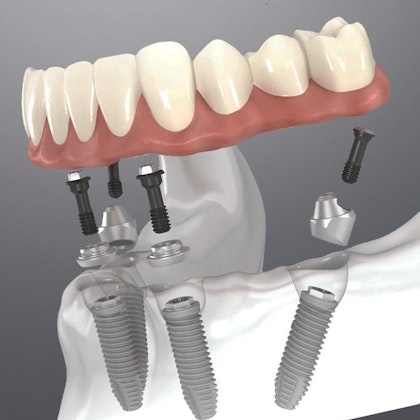 Illustration of All-on-4 implants
