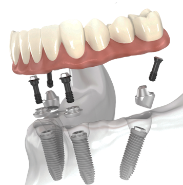 Dentures Lake Charles, LA - Lake Area Dentistry