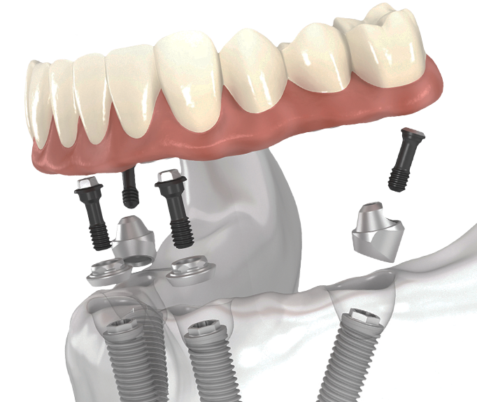 All-On-4 implants