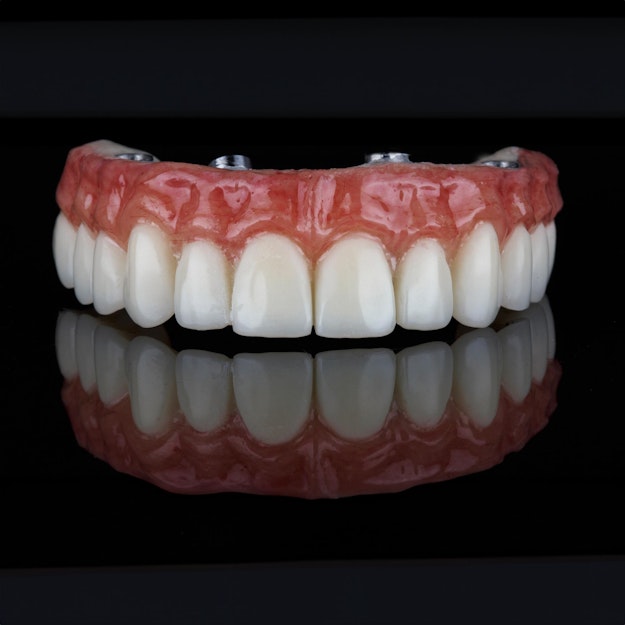 implant-supported denture