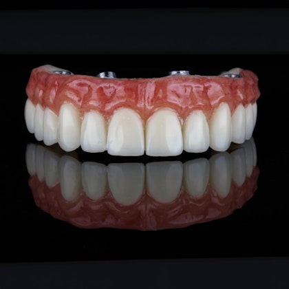 Snap on denture with implants