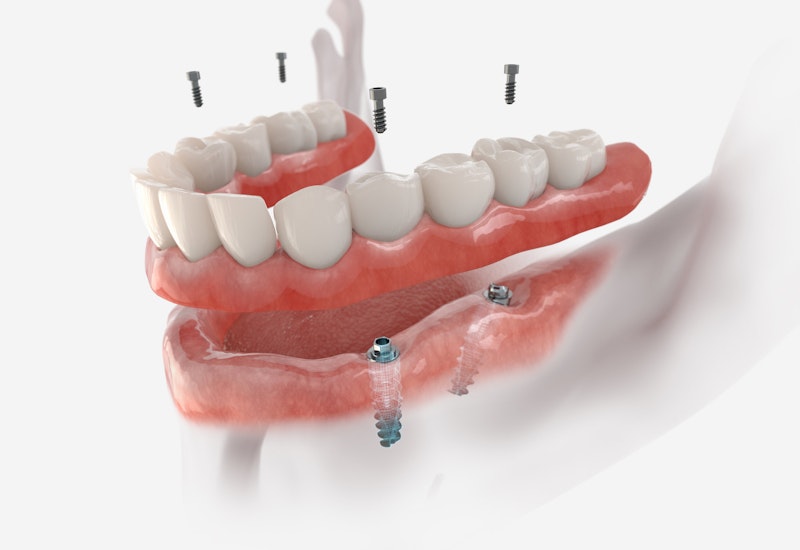 illustration showing how a dental implants denture are placed in the jaw