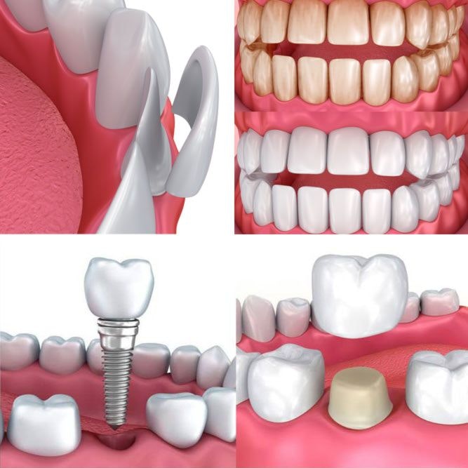 smile makeover