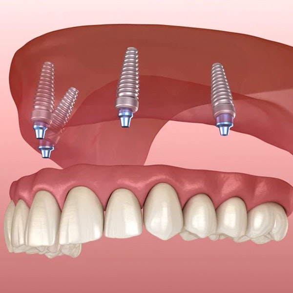 All-on-4 Implants