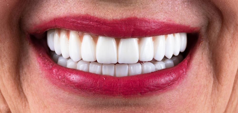 Woman with All-on-4 Dental Implants and bright smile