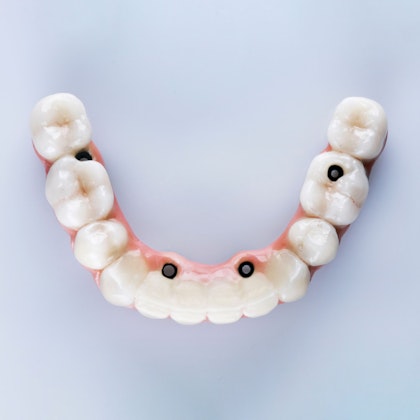 model of an all on 4 dental implant