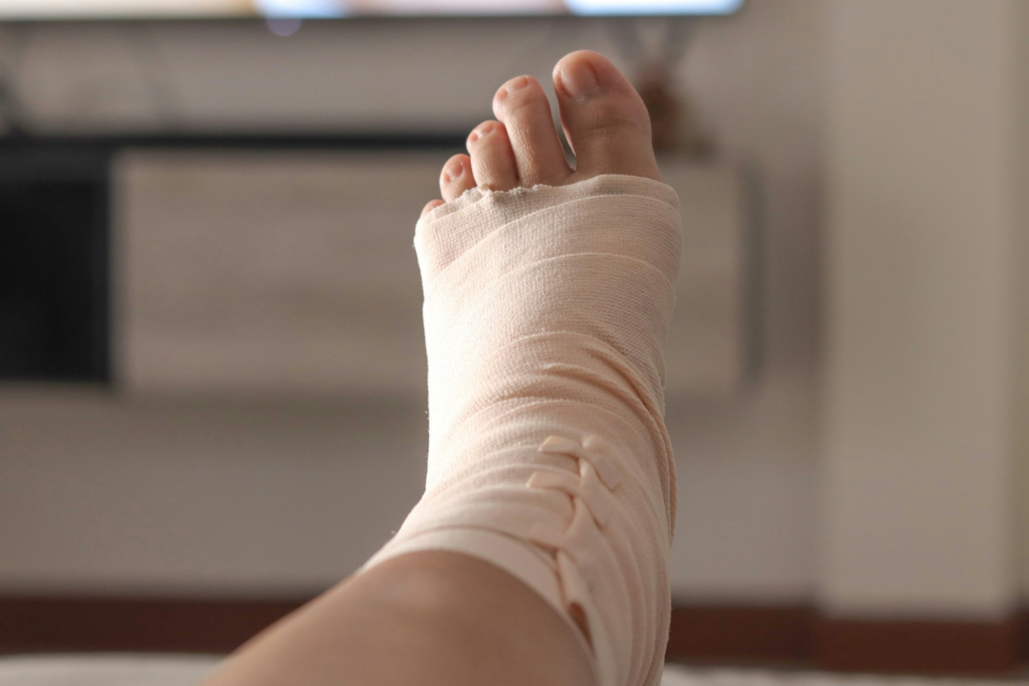 Ankle in a cast