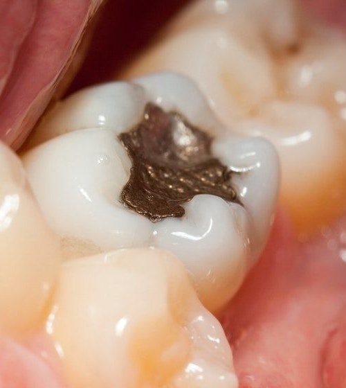 amalgam filling