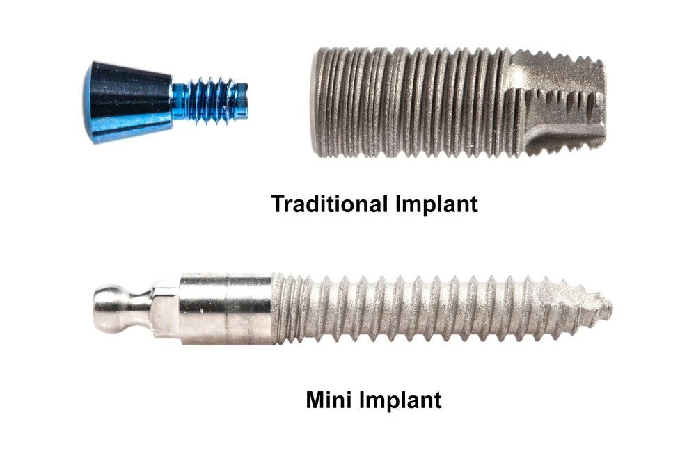 Traditional dental implant vs. a mini dental implant