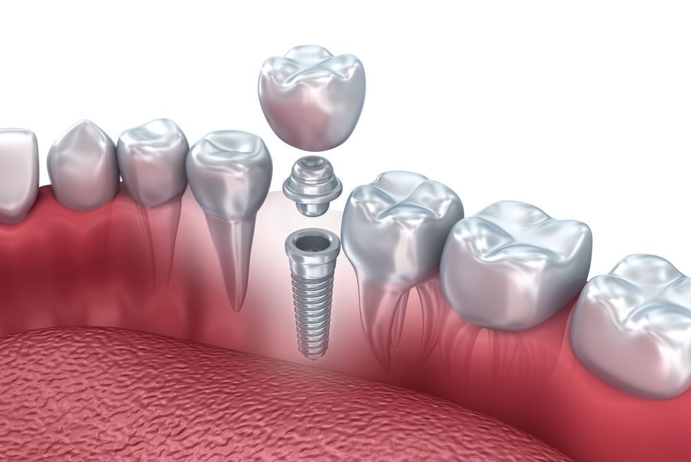 Parts of dental implant crown