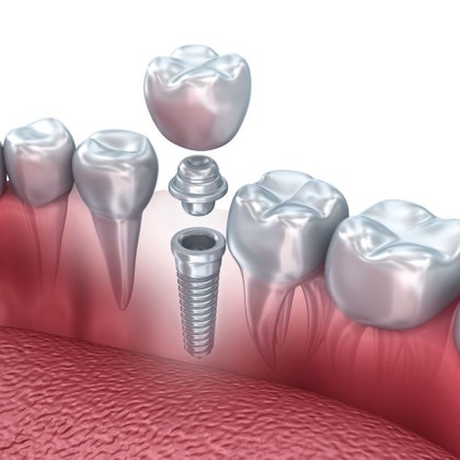 parts of a dental implant