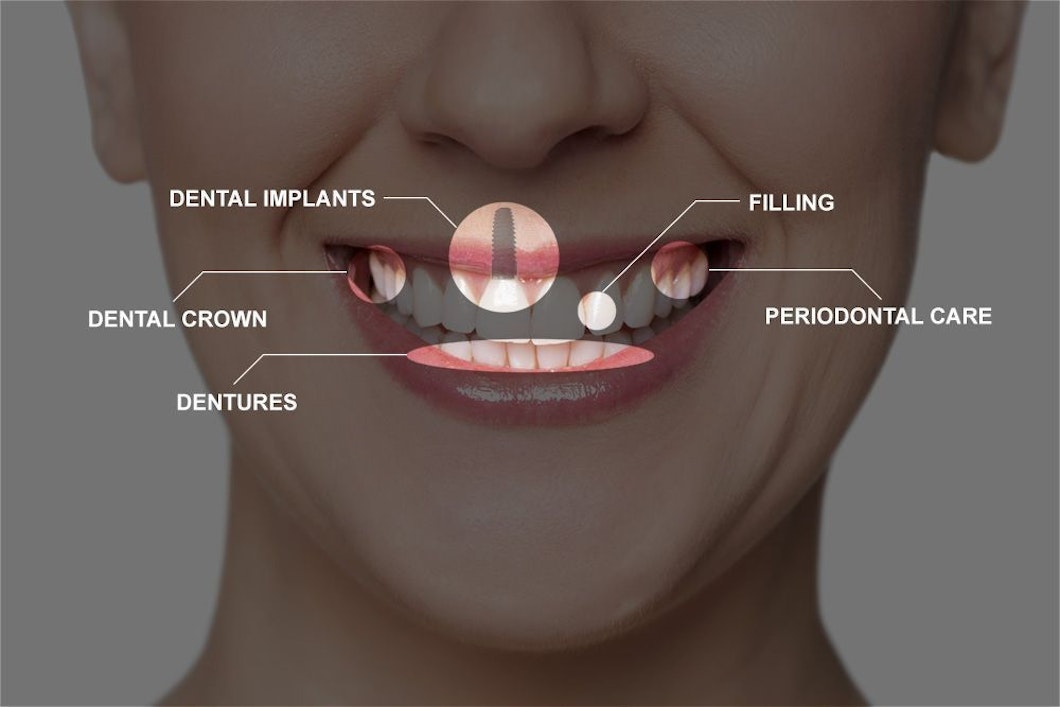 Illustration showing full mouth reconstruction treatment options