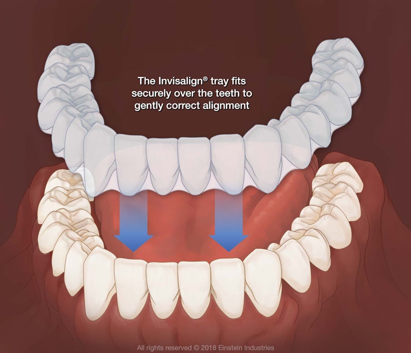 Invisalign tray fits securely over the teeth to gently correct alignment
