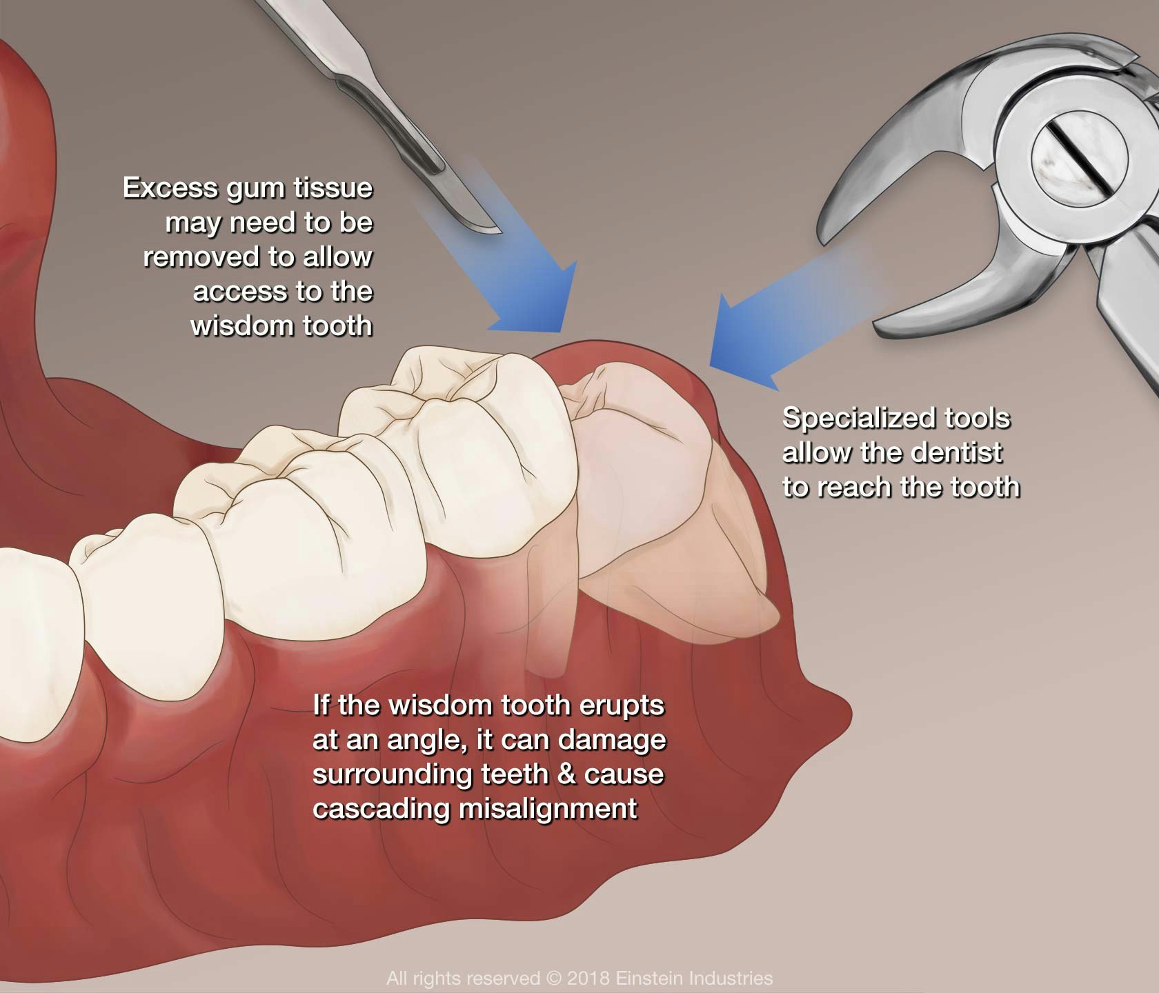 Excess gum tissue may need to be removed to allow access to the wisdom tooth. Specialized tools allow the dentist to reach the tooth. If the wisdom tooth erupts at an angle, it can damage surrounding teeth & cause cascading misalignment.