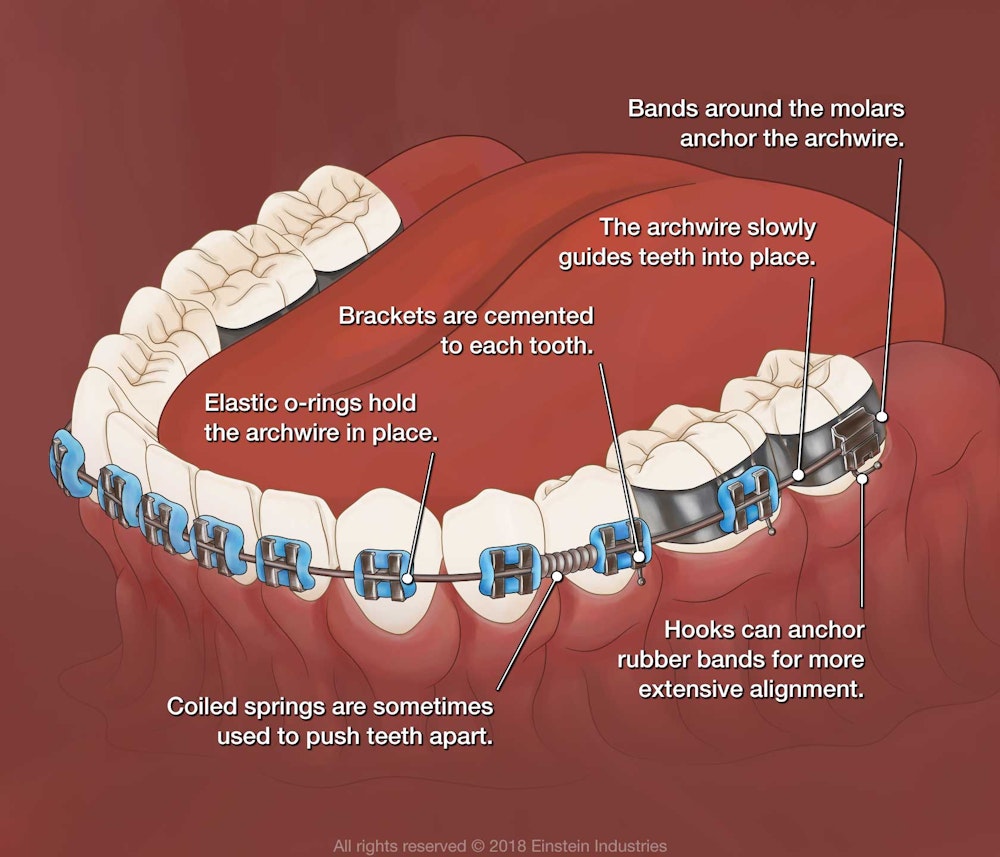 Bands around the molars anchor the archwire. The archwire slowly guides teeth into place. Hooks can anchor rubber bands for more extensive alignment. Brackets are cemented to each tooth. Elastic o-rings hold the archwire in place. Coiled springs are sometimes used to push teeth apart.