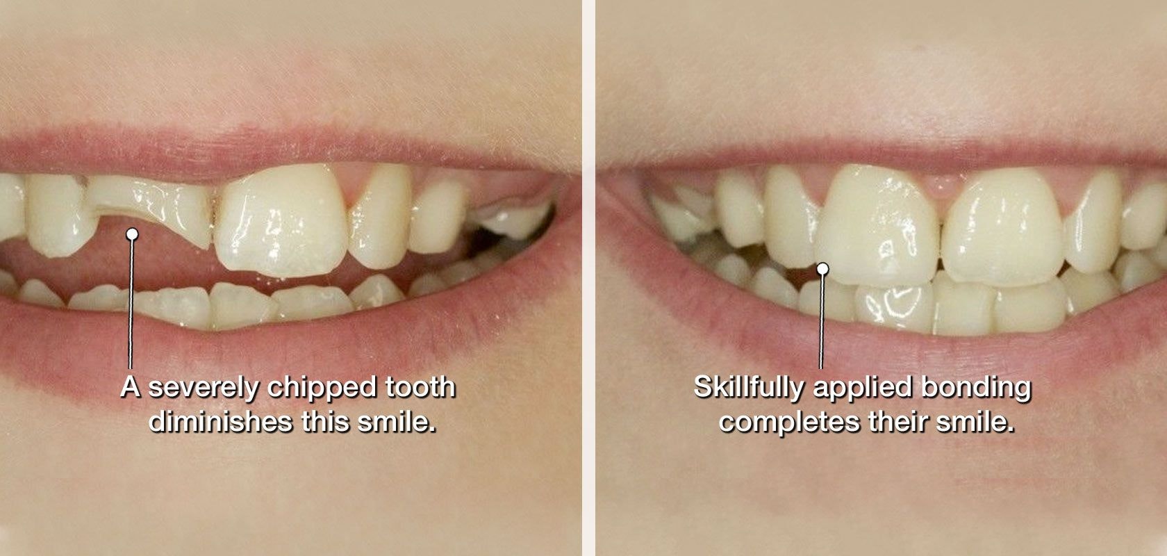 Before and after of dental bonding