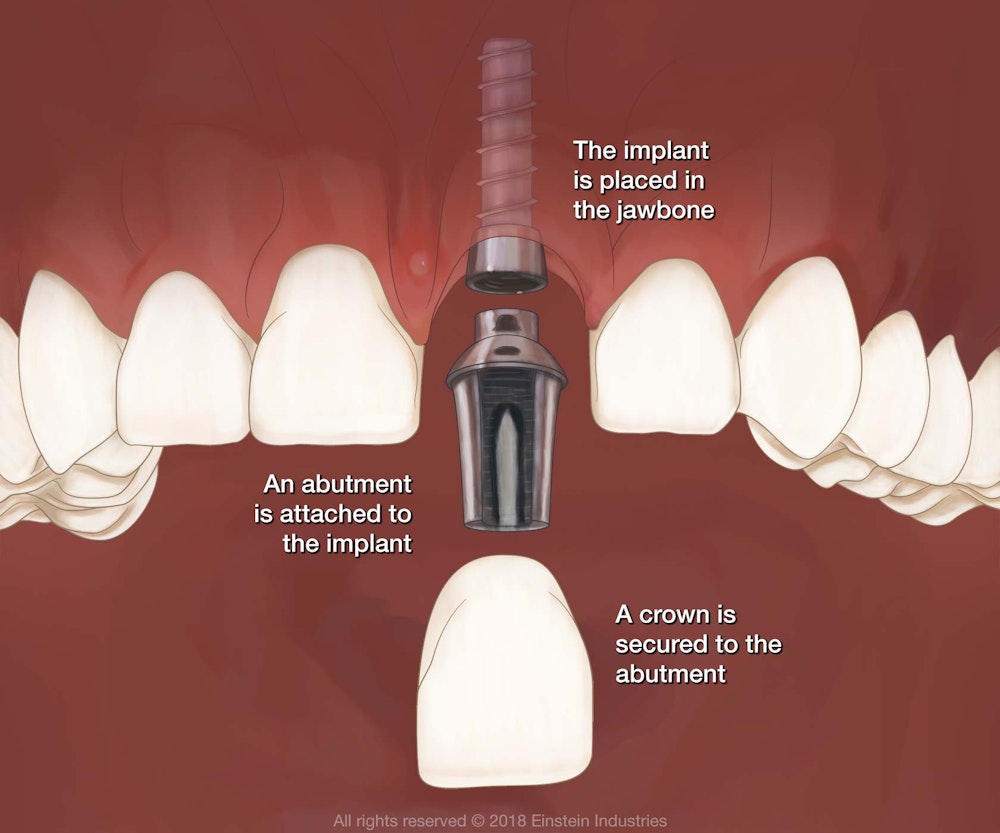 Dental Implant diagram where the implant is placed in the jawbone. An abutment is attached to the implant. A crown is secured to the abutment.