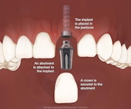 Dental Implants Edmonton AB Implant Dentistry Smiles First Corporation