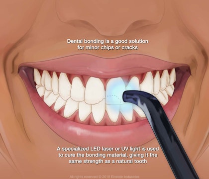 Image of dental bonding