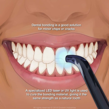 Image of dental bonding
