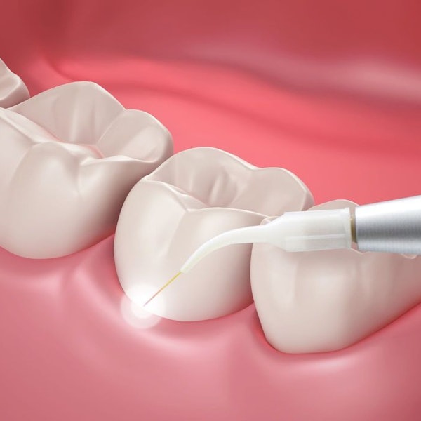 Gum contouring with laser