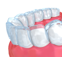 Invisalign aligner covering teeth