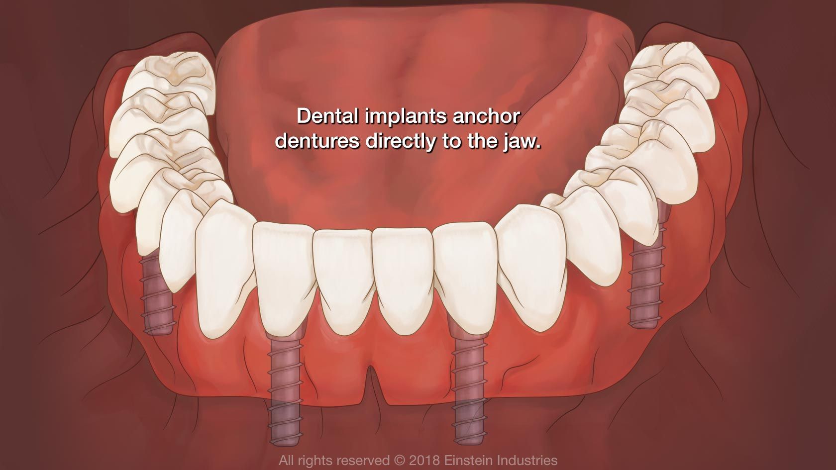 Dental Implants Slidell, LA - Implant Dentistry - Oak Harbor Family ...