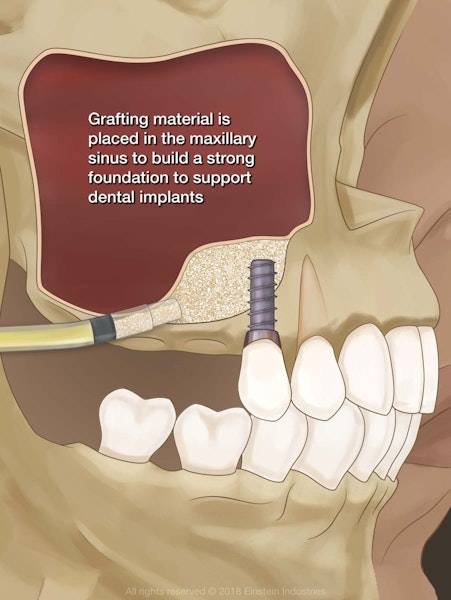Diagram of a sinus lift