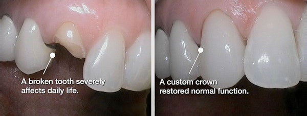 custom dental crown