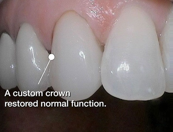 custom dental crown
