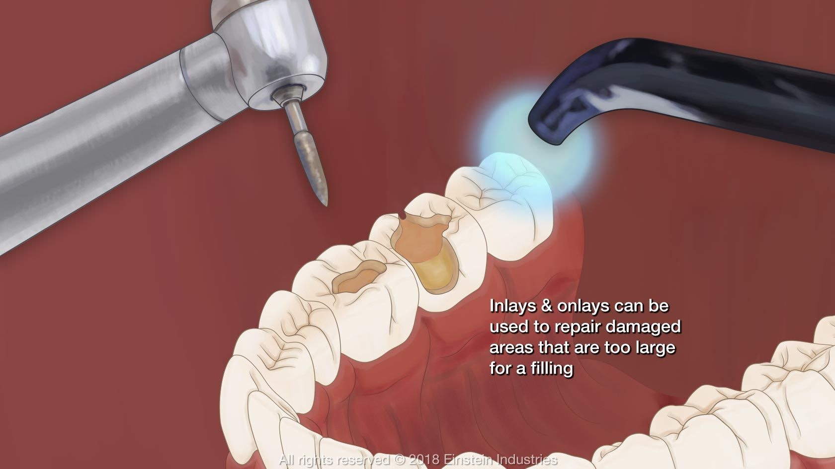 What Is A Leaky Filling? - Gentle Dental Maine