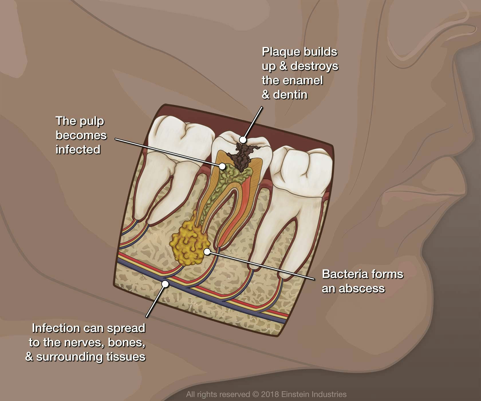 Diagram of infected root canal