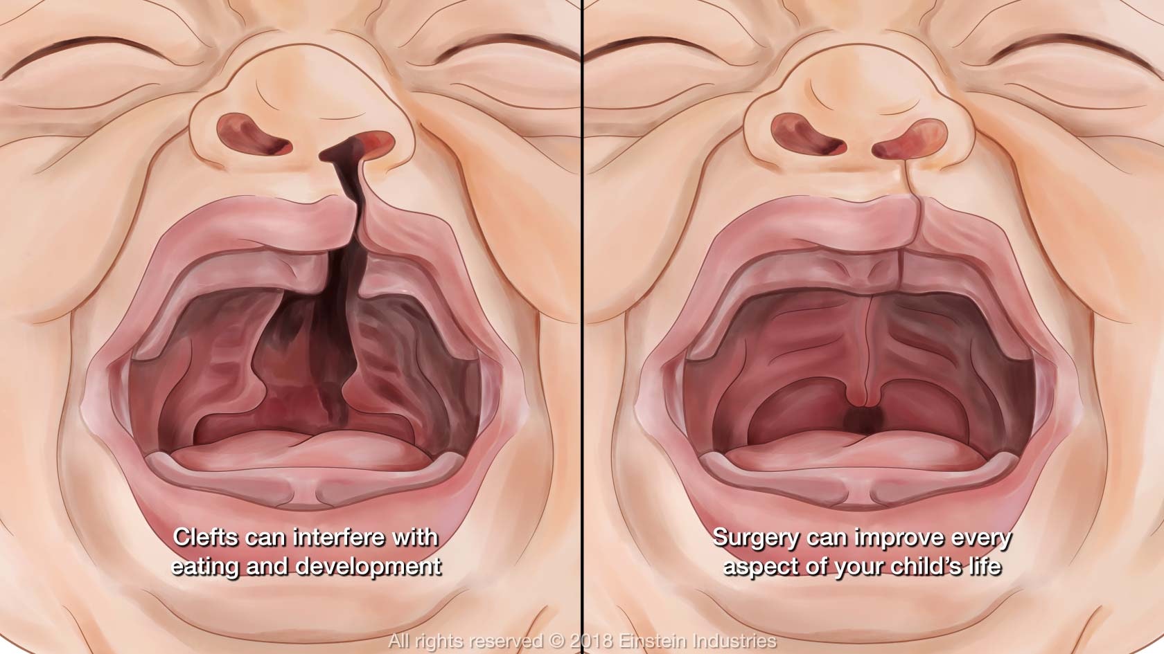 Clefts can interfere with eating and development. Surgery can improve every aspect of your child's life.
