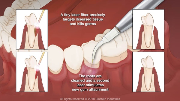 Illustration stating a tiny laser fiber precisely targets diseased tissue and kills germs. The roots are cleaned and a second laser stimulates new gum attachment.
