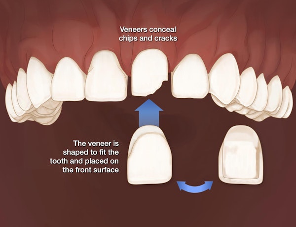 Veneers conceal chips and cracks. The veneer is shaped to fit the tooth and placed on the front surface.