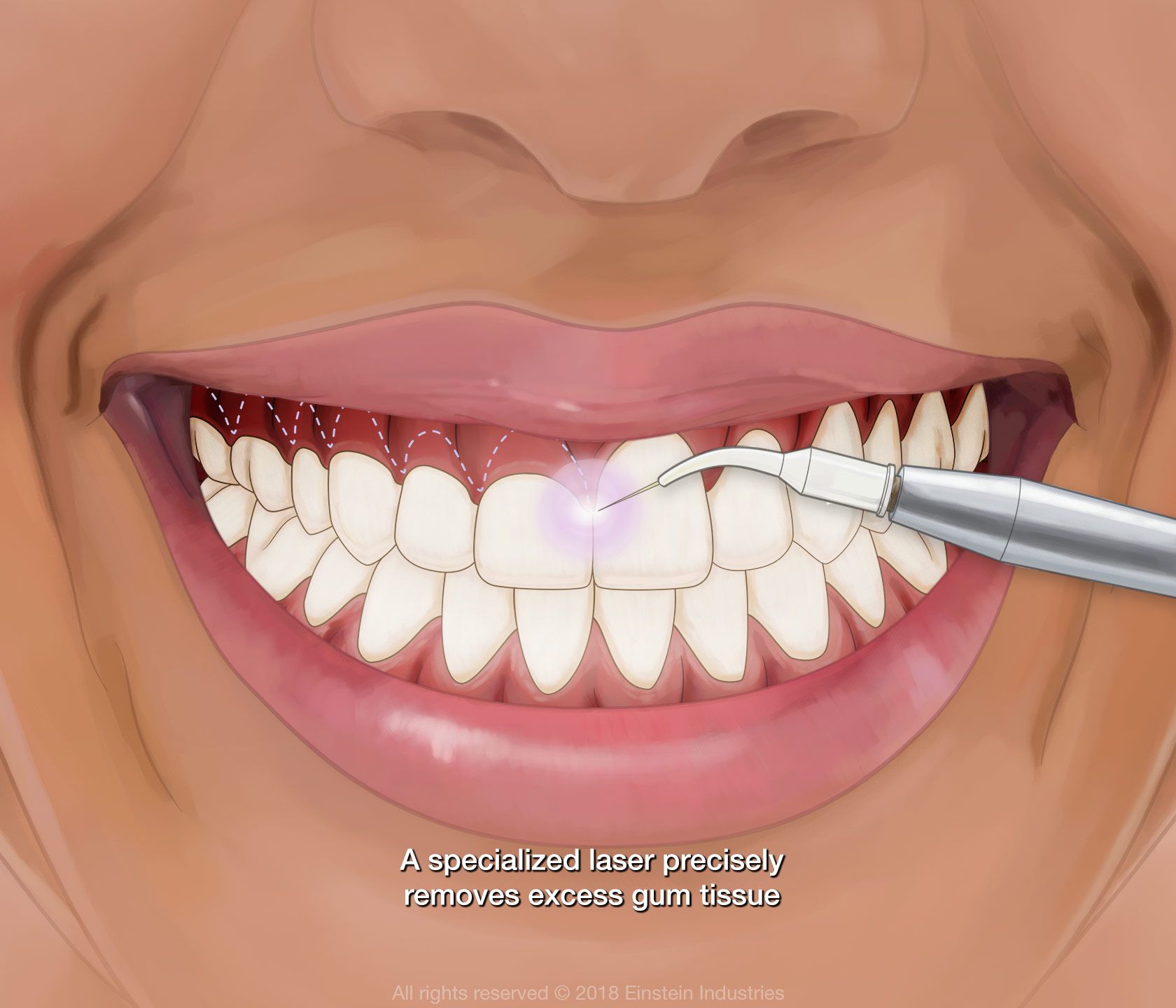 Gum contouring and gum grafts: before and after transformation