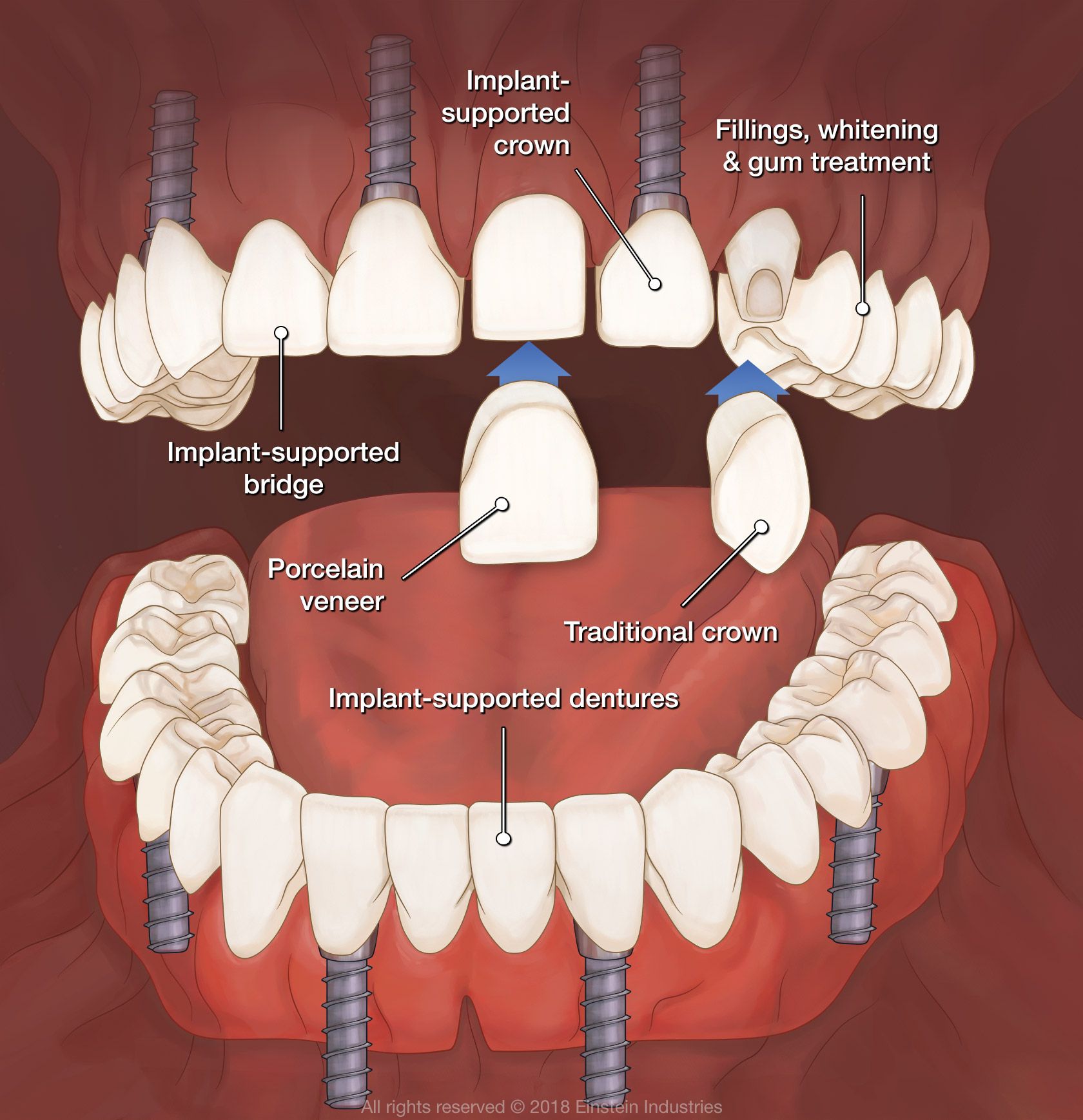 full mouth extraction