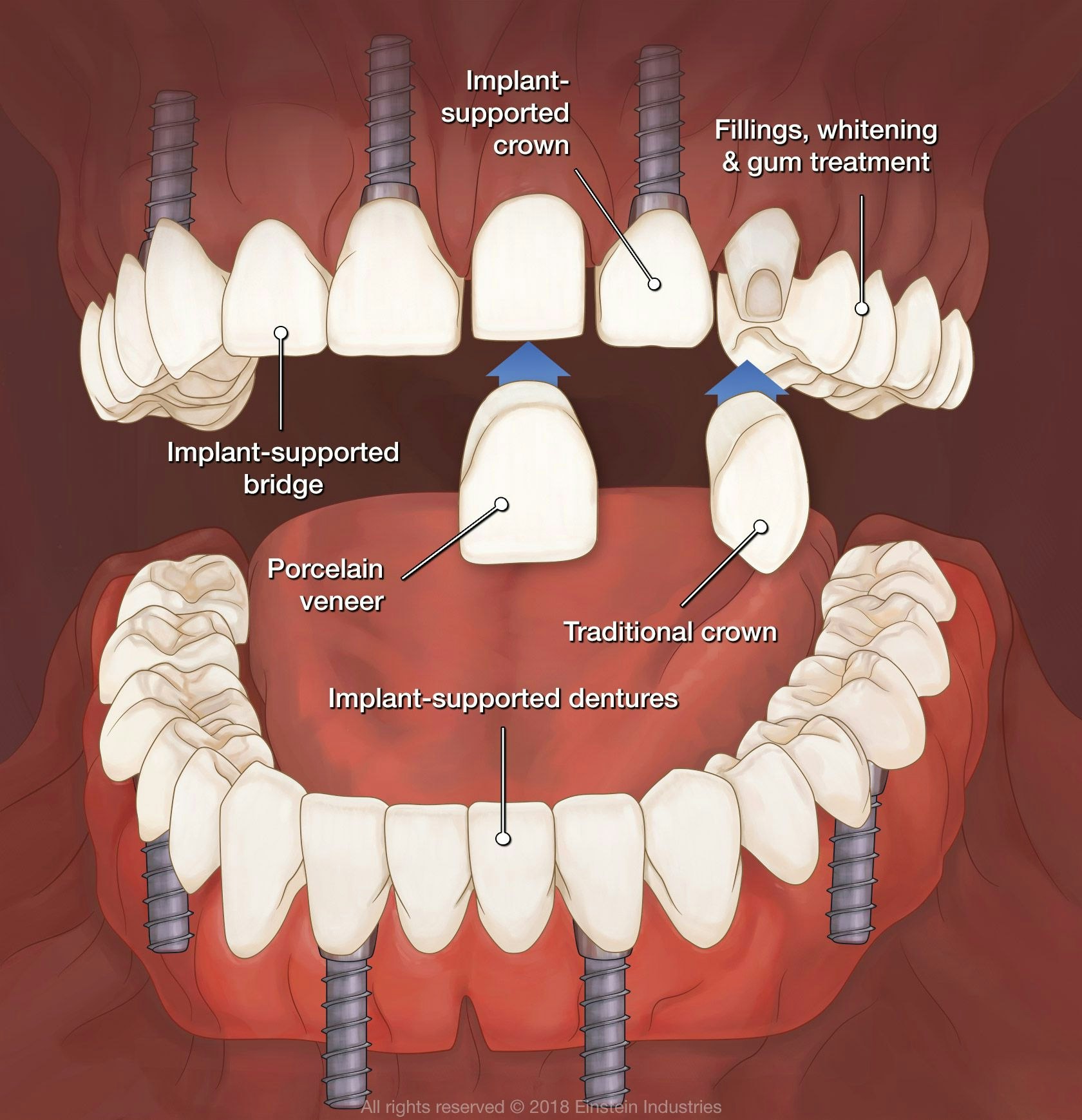 Full mouth reconstruction diagram