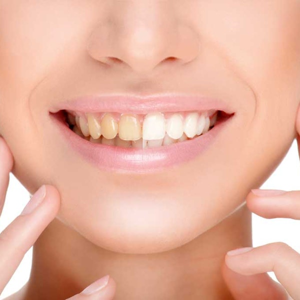 Before and after whitening