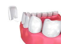 dental veneer going onto a tooth
