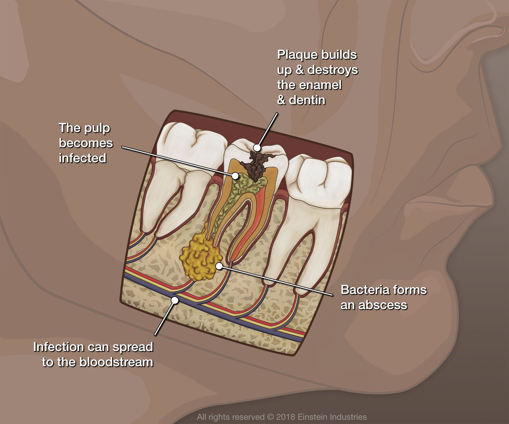 Can A Tooth Infection Spread To Your Lungs