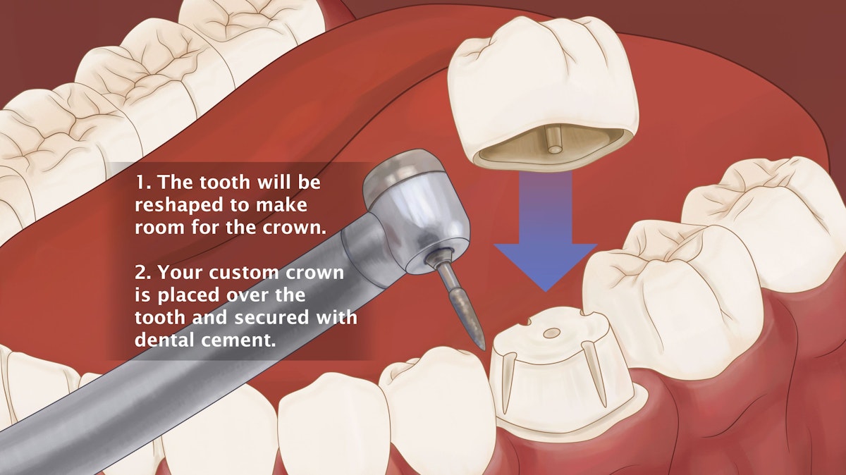Dental Crown Einstein Media Graphic