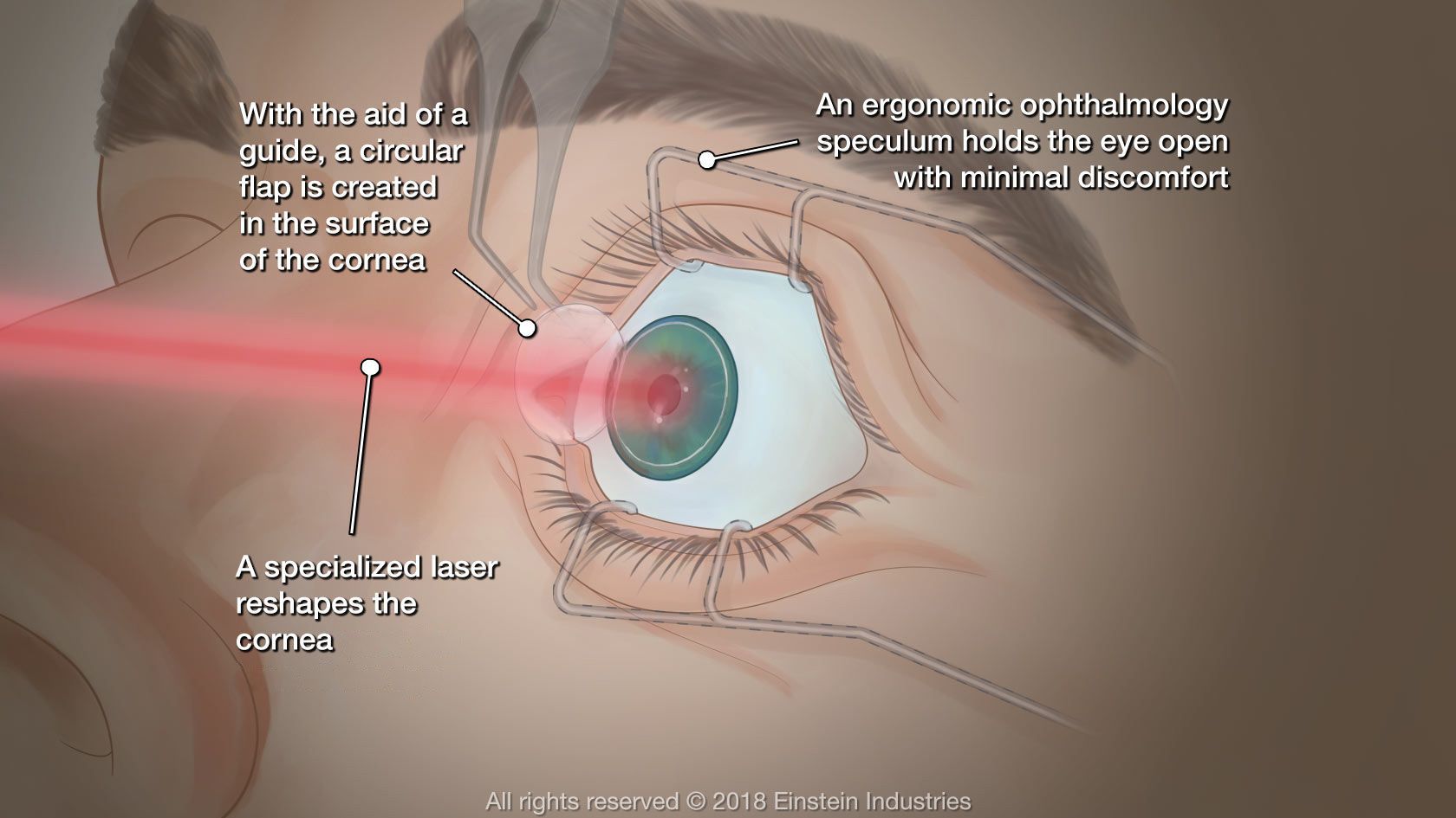 lasik