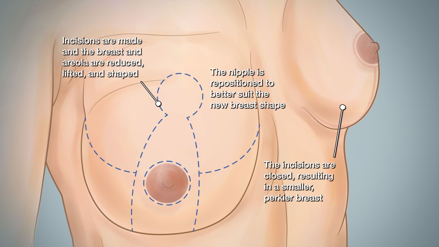 Incisions are made and the breast and areola are reduced, lifted, and shaped. The nipple is repositioned to better suit the new breast shape. The incisions are closed, resulting in a smaller, perkier breast.