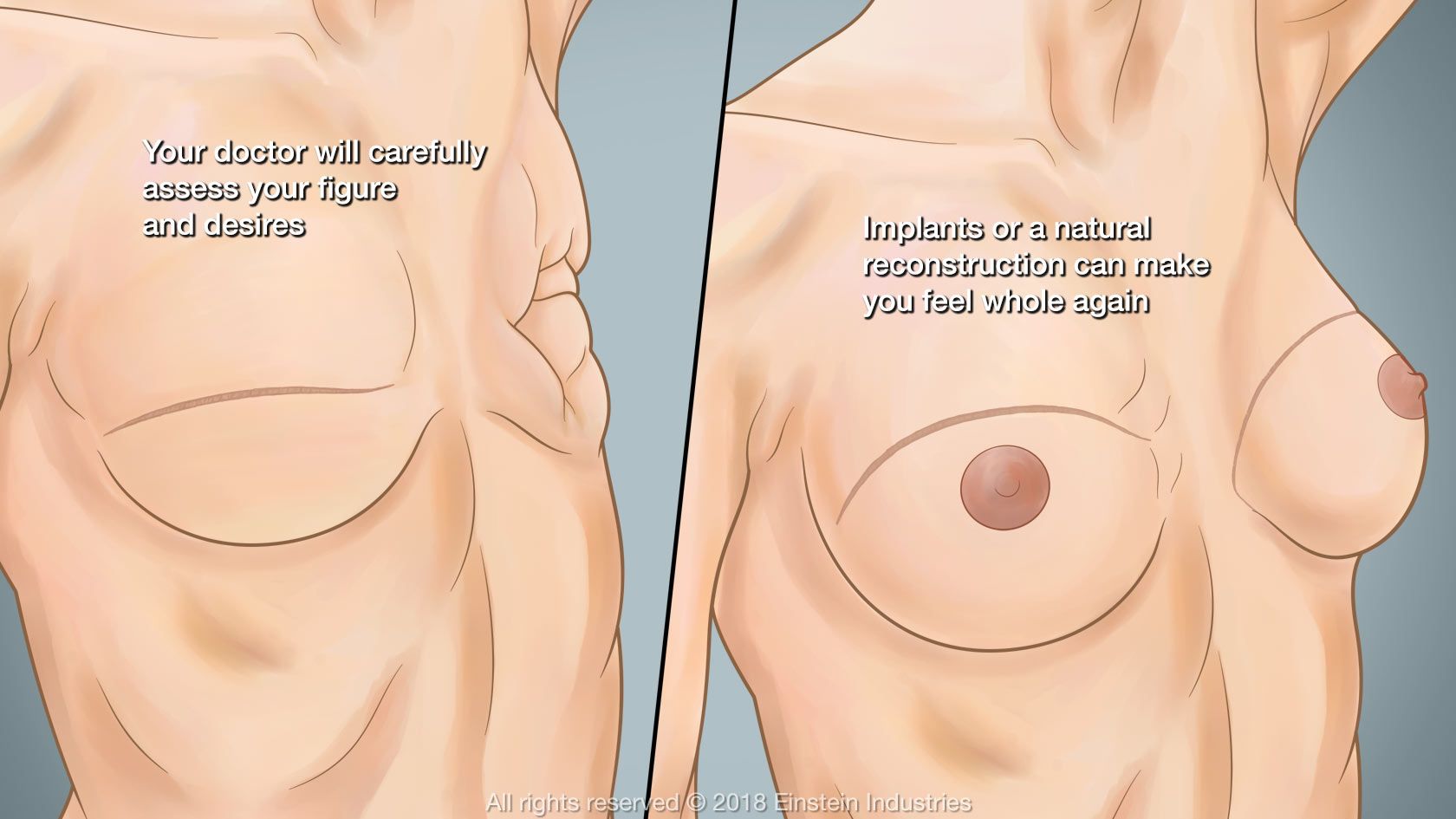 Your Doctor will carefully assess your figure and desires. Implants or a natural reconstruction can make you feel whole again.