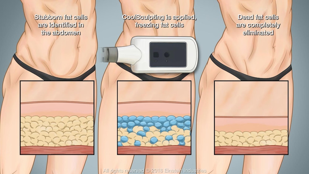 Coolsculpting diagram
