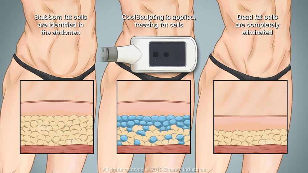 Coolsculpting diagram