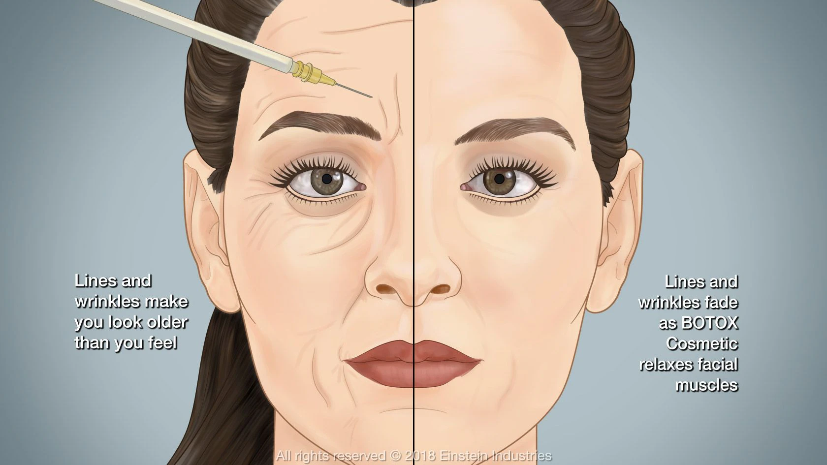 how BOTOX works